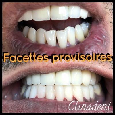 Réalisation de facettes dentaires au centre Clinadent Marseille Negresko