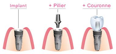Composants implant dentaire Marseille 13008